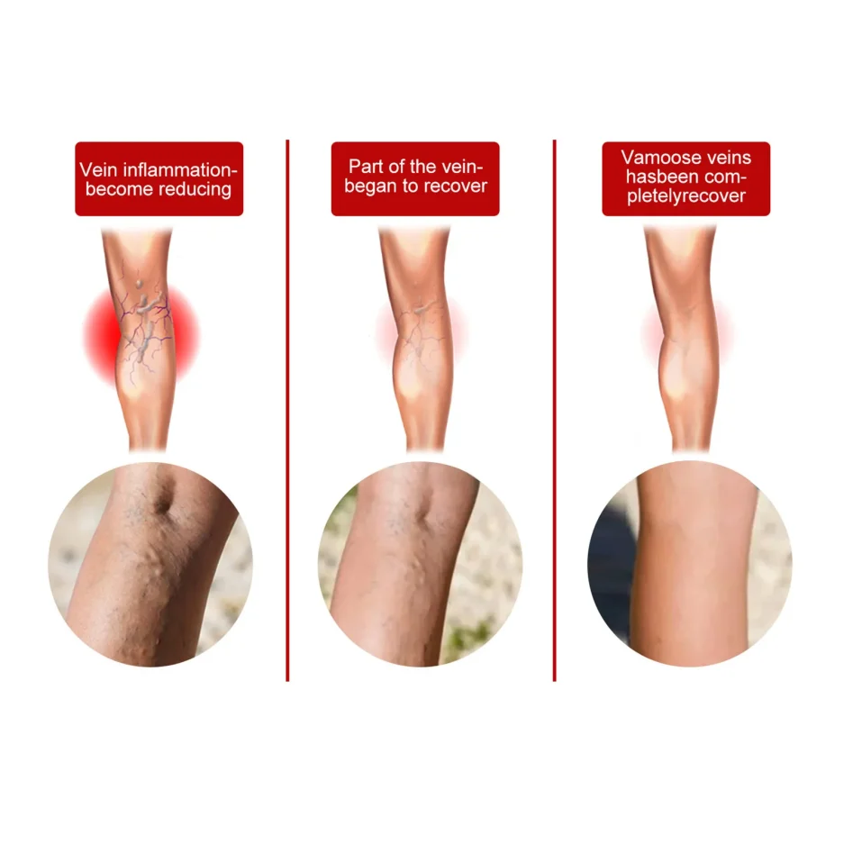 Varicose Vein Patch Circulation Paste for Legs Soothing Leg Treat Improves The Appearance of Varicose Vein Personal Health Care - Image 2